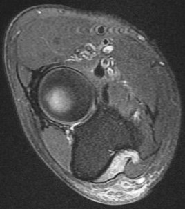 Figure 2 for case Ulnar neuritis and denervation of the flexor digitorum profundus